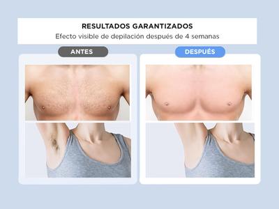 Cara La Luz Pulsada Sirve Para Eliminar Manchas Shop Maquina De