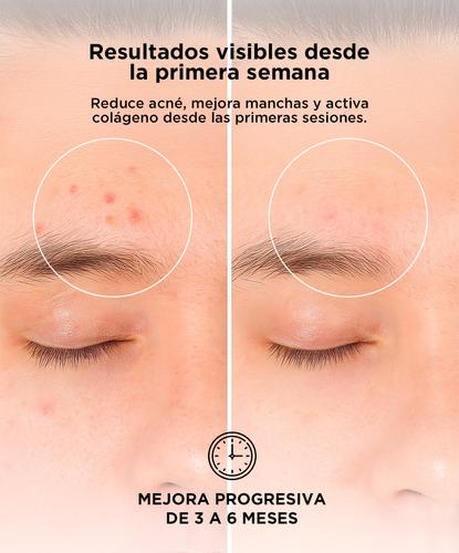 Mascara Facial Led Gadnic LT3.0 Terapia Acné Rejuvenecimiento  - 4