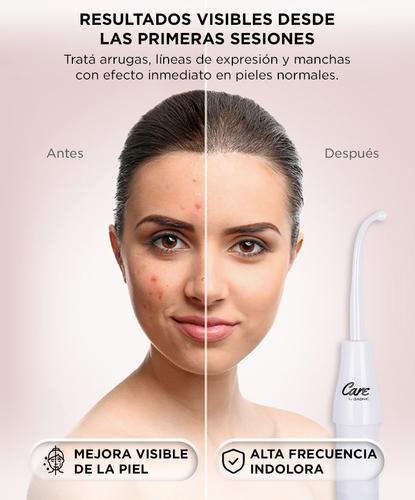  Equipo de Alta Frecuencia Gadnic LF60 – Antienvejecimiento Antiacné Reafirmante Facial 4 Electrodos - 2